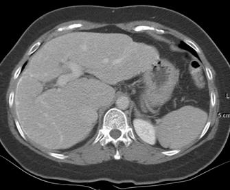 Axial intravenous contrast-enhanced CT at a lower level in the pelvis shows similar tram-track calcificaton pattern of the mucosal surface of the sigmoid colon (arrows).