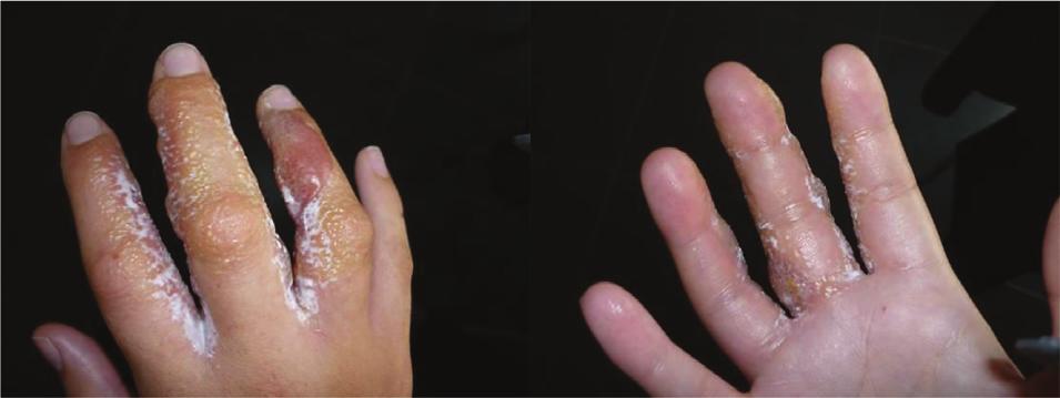Fig. 2. Severe dermatitis of the right hand following the application of ethylhexylglycerin-containing sunscreens onto her children s skin (case 11). Fig. 3.
