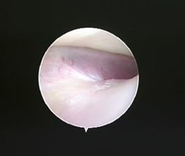 With this ideas in mind we extended the use of arthroscopic eminoplasty for treating some TMD such as anchored disk syndrome, TMJ habitual dislocation and internal derangement.