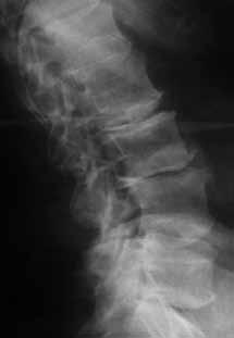 Postoperative Visit History of Present Illness and Radiographs: 57 year old male presented with a bilateral back, buttock and thigh pain and reports symptoms had progressively worsened for the last 5