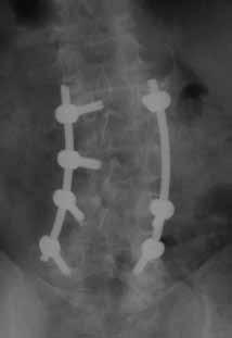 degenerative scoliotic curve in the lumbar spine (Figures 1 and 2) Treatment Method and Materials: Interbody fusions and releases of the deformity were performed at the L2 - L5 disc spaces using a