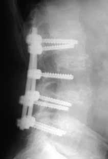 Bilateral decortication of the facet joints for fusion was also performed at L2 - L5 at this time Using the same skin incisions, seven percutaneous VIPER pedicle screws were placed under fluoroscopic