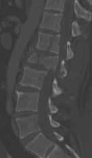 Percutaneous Spinal Trauma Treatment Using the VIPER 2 System Tony Tannoury, MD Boston University, Department of Orthopaedics TRAUMA Figure 1: Lateral CT Scan Figure 2: Axial CT of L1 Figure
