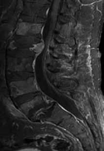 Illness and Imaging: A 56 year old male with a squamous cell tumor in L2, collapse of the L2 vertebral body and accompanying severe stenosis at the spinal canal (Figure 1) Imaging revealed lesions at