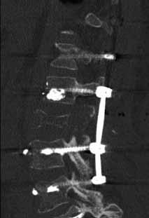 retractor placed through a 30mm mid-line incision Vertebroplasties were performed at L1, L3, L4 and L5 to support the weaken bone Ten Percutaneous VIPER Screws were placed bi-laterally at T11 - L3