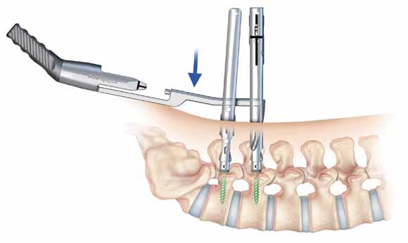 curves Truly percutaneous rod introduction options optimized for short & long