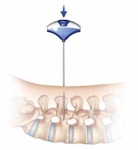 Pedicle Targeting Jam Shidi needle placement A longitudinal incision about 1.5cm is made through the skin and fascia. (An incision of 1.