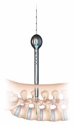 Pedicle Preparation Two options are provided for dilating soft tissue in preparation for tapping Option 1: A Combined Dilator/Cannula Insert the 7mm dilator with handle into the Pedicle Preparation
