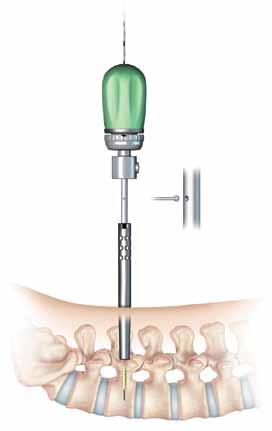 system guide Tap Pedicle While controlling the tap sheath or the tap cannula, advance the appropriate size Cannulated Self-Drilling Tap over the guidewire into the pedicle by turning the tap in a
