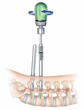 system guide To maintain full polyaxial capability, the Screw Head should not be fully seated against the bone Once the screw is inserted to the desired depth, remove the Polyaxial Driver or X-Tab