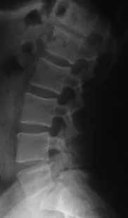 intense lower back and leg pain who previously underwent, L4 - S1 laminectomy and discectomy five years ago Her symptoms gradually worsened over the past 5 years and currently
