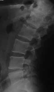 Treatment Method and Materials: Two level interbody fusions were performed from an anterior approach at L4/L5 and L5/S1 The graft was secured using an AEGIS lumbar plate at L5/S1