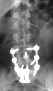 of pre-operative symptoms At three months follow up, radiographs demonstrated evidence of fusion and good alignment at operative levels (Figures 4 and 5) Presently, she reports good