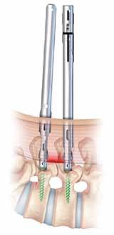 incisions insert & rotate
