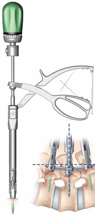 system guide Simple PERCUTANEOUS Reduction Options Comprehensive internal rod reduction options to simplify even the most difficult