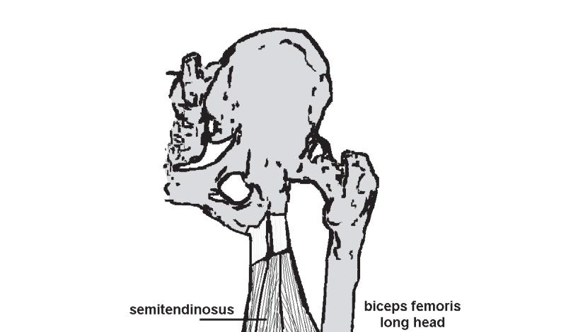[ clinical commentary ] A Semitendinosus Semimembranosus Biceps femoris long head Biceps femoris short head Hamstring injuries that occur during activities such as dancing or kicking can occur during