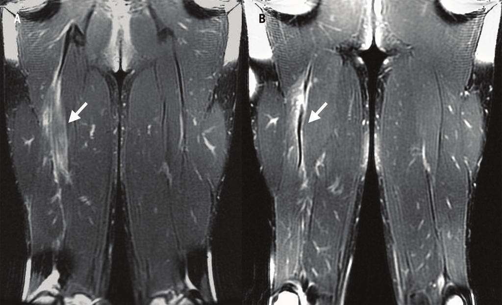 FIGURE 2. T2-weighted coronal images at (A) 10 days and (B) 30 days following injury to the right biceps femoris long head sustained during high-speed running.