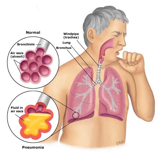 Page 8 of 8 GRAPHICS Pneumonia "Alveoli" are air sacs in your lungs that are surrounded by tiny blood vessels called capillaries. The air sacs have thin walls that allow the exchange of gases.