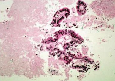 T. Serizawa, et al. FIG. 3. Photomicrograph obtained in Case 1. Histopathological examination confirmed viable tumor cells. H & E. lesions (43.