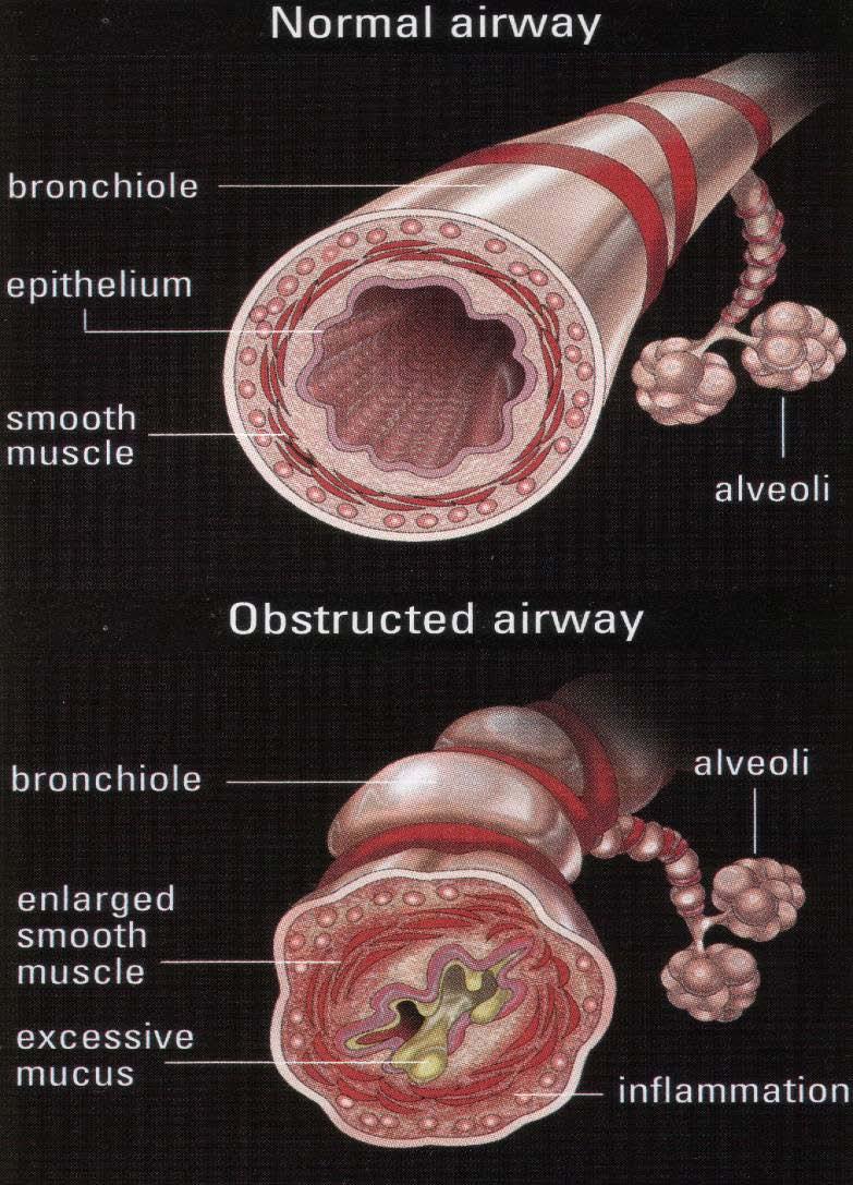 Chronic Obstructive Pulmonary