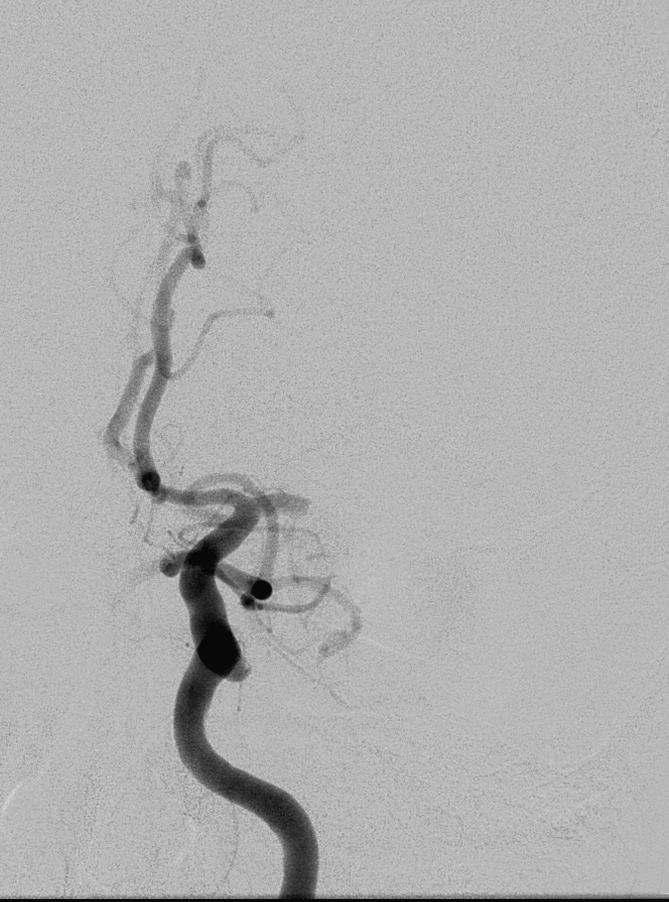 CASE 1 CONTINUED The angiogram confirmed occlusion of the left
