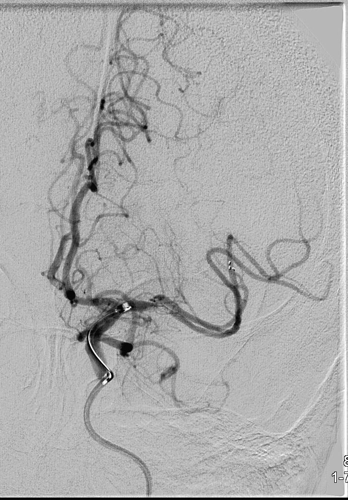 CASE 1 CONTINUED Mechanical thrombectomy with
