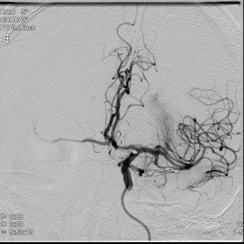 performed with successful TICI (Thrombolysis