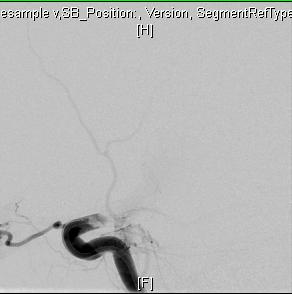 Compete recanalization of the left internal carotid artery occlusion was