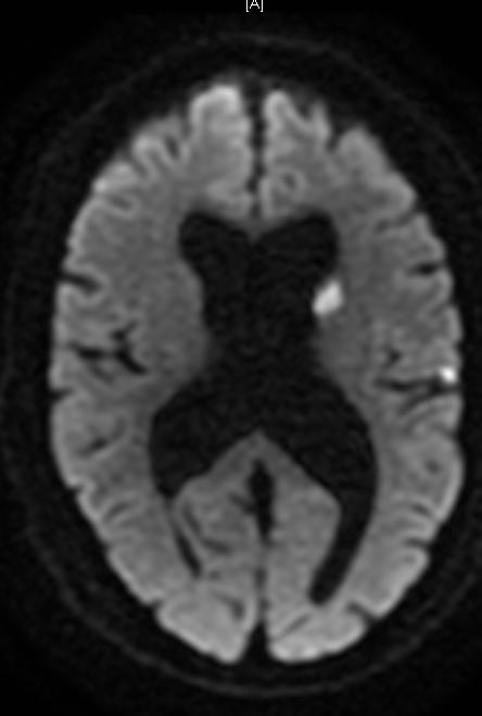 Follow-up MRI shows evidence of multiple