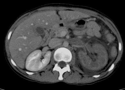 Cases 5 32 year old presents with abdominal pain, hematuria Unilateral Delayed