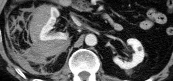 Cases 7 73 year old on rivaroxaban with acute flank pain Unilateral Delayed Nephrogram Spontaneous subcapsular hematoma associated with anticoagulation There is a large subcapsular hematoma on the