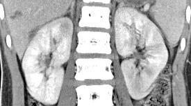 Cases 9 15 year old s/p MVA Bilateral Striated Nephrogram Renal contusions