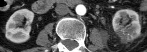 Cases 12 66 year old with abdominal pain Spotted Nephrogram Vasculitis (polyarteritis nodosa) Wedge shaped