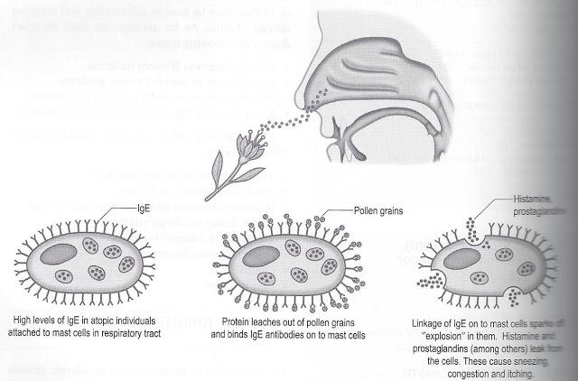 [figure 1] Antigen-antibody reaction in allergic rhinitis [7] 2. Thick and Sticky Nasal Discharge It is accompanied by nasal obstruction and loss of the sense of smell.