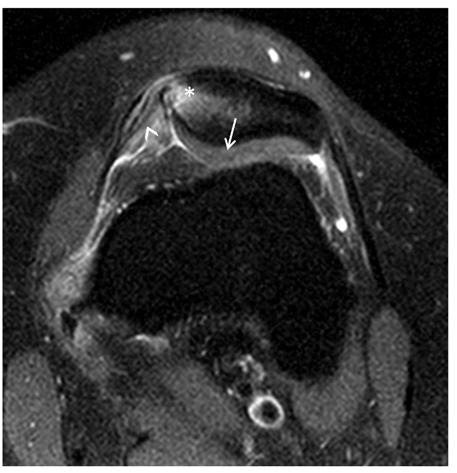 Table 2. Patellar cartilage injury in initial and follow-up MRI.