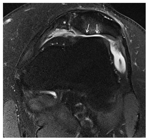 Primary MRI (N=20) Follow-up MRI (N=20) p-values Patellofemoral cartilage subregion Cartilage injury, number of patients Median ICRS (range 0-4) Cartilage Injury, number of patients Median ICRS