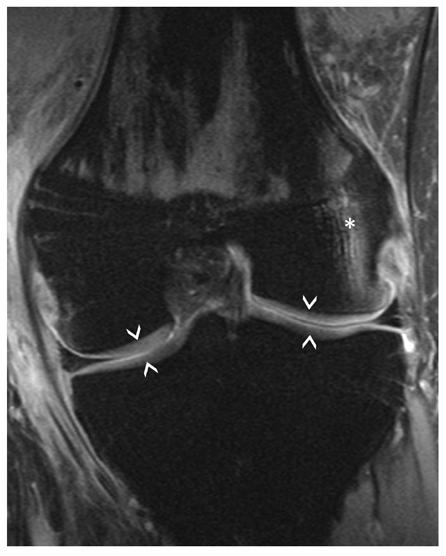 Bone bruises (asterisks) visible on the medial side of the patella and the lateral femoral condyle indicate recent patellar dislocation.