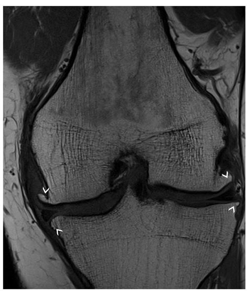 patella (thick arrow) and at the center and lateral thirds of the trochlea (thin arrows), where grade