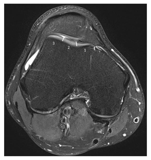 Figure 2. Right knee. Axial PD fat sat image at the level of the trochlear cartilage.