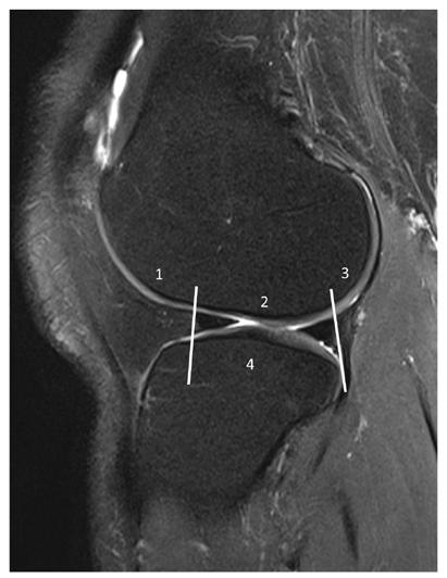 Figure 3. Sagittal plane PD fat sat image of the lateral compartment of the tibiofemoral joint.