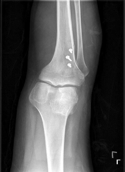 30 flexion; and the merchant view), and computed tomography. We found that the patient had a varus hipknee-ankle angle of 6 (Fig. 1A), a TT-TG distance of 20.1 mm (Fig. 1B), and a patella tilt of 52.