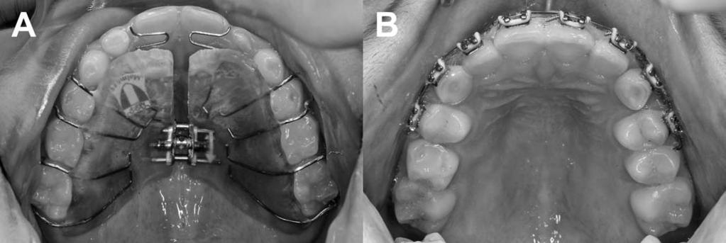 192 WIEDEL, BONDEMARK Figure 3. Occlusl view of (A) the removble orthodontic pplince nd (B) the fixed orthodontic pplince.