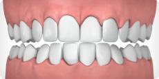 Treatable cases Overcrowded teeth This occurs when there is a lack of room within your jaw for all of