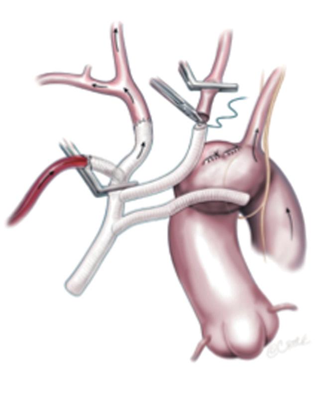 Left hemispheric cerebral perfusion during construction of the left common carotid anastomosis is maintained via the same collaterals; (D) subclavian anastomosis is