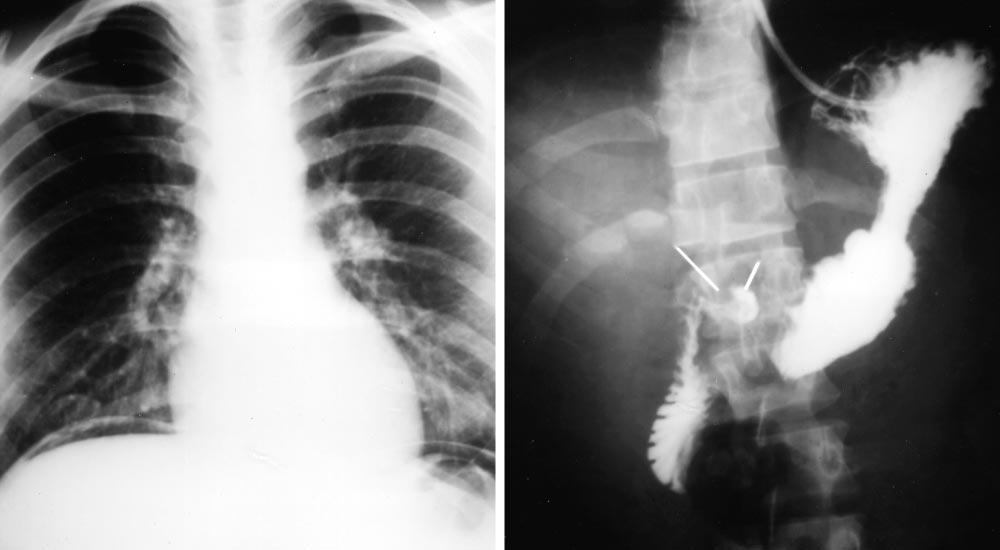 No Spill Ulcer Air Figure 1. Left, Radiogram demonstrates free subdiaphragmatic air.