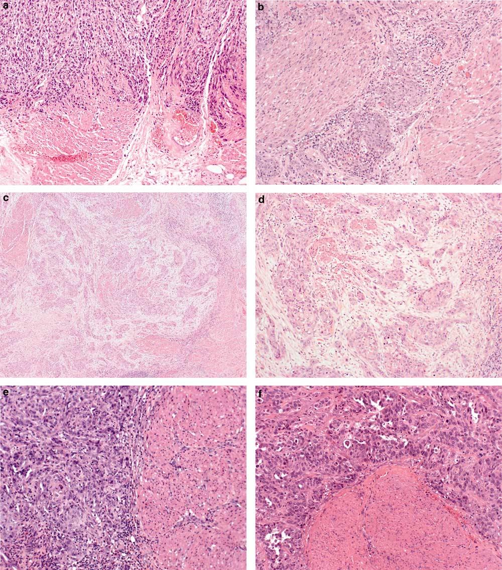 S81 Figure 13 pt2 urothelial carcinoma. (a) pt2 urothelial carcinoma invades into muscularis propria. Infiltrating tumor cells permeate the thick muscularis propria wall.