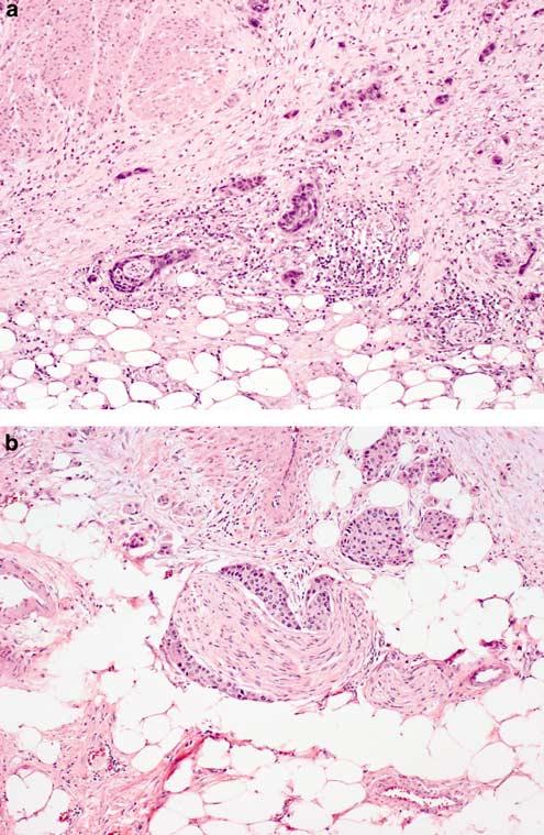Figure 15 pt3 urothelial carcinoma. (a) Tumor invades into perivesical adipose tissue. (b) Perineural invasion is present. The prognostic significance of perineural invasion is uncertain.