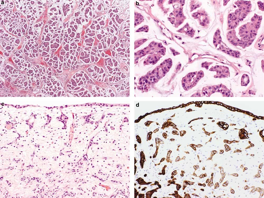 S88 Figure 19 Micropapillary (a and b) and nested (c and d) variants of urothelial carcinoma. These variants are associated with poor prognosis and aggressive treatment is warranted.