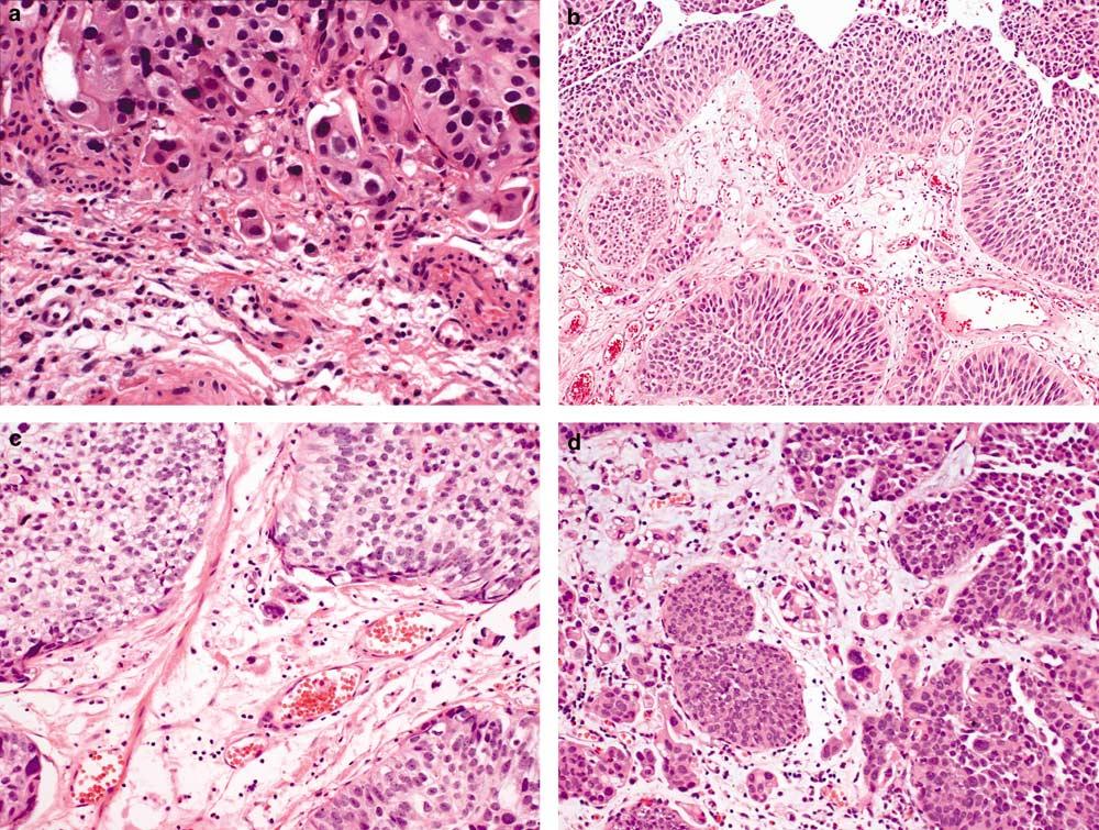 S72 Figure 2 pt1 urothelial carcinoma with different invasive patterns. (a) The smooth contour of basement membrane is disrupted in infiltrating tumor cells.