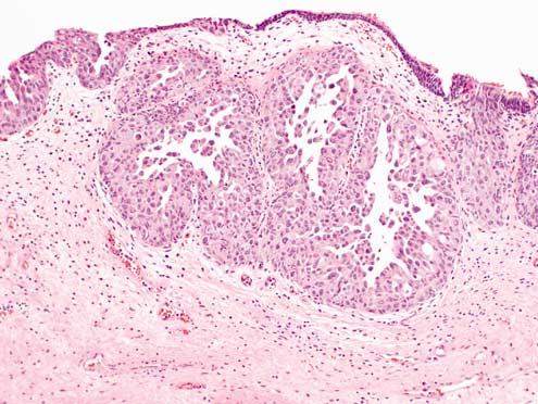 Figure 6 Urothelial carcinoma may involve von Brunn s nests. The smooth regular contour of basement membrane, however, is preserved. Definite stromal invasion is not seen.